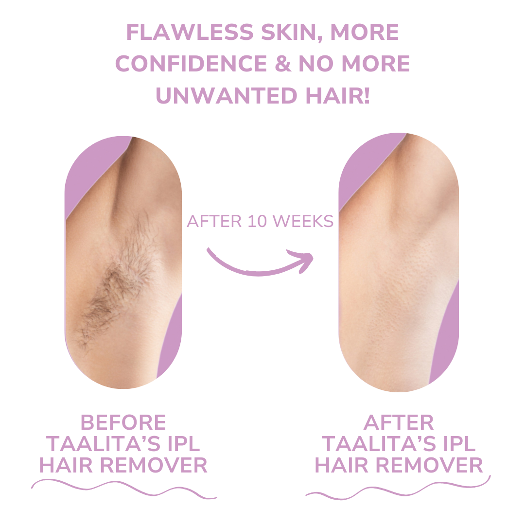 Naldony IPL Hair Remover I The leading laser hair removal for your home