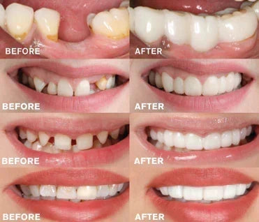 Clip-on dental veneer | Tooth-supported design, no adhesive | For a radiant smile without a dentist visit
