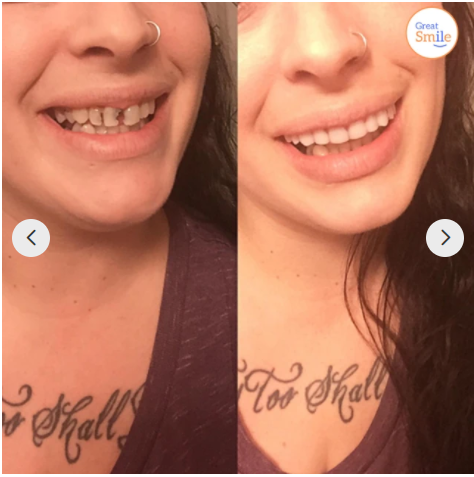 Clip-on dental veneer | Tooth-supported design, no adhesive | For a radiant smile without a dentist visit