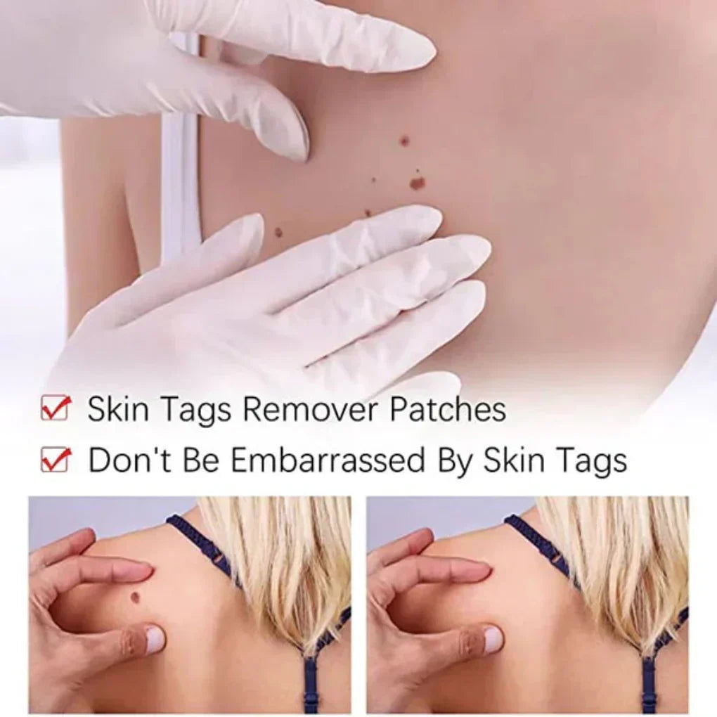 Natural Skin Tag & Mole Remover Pen